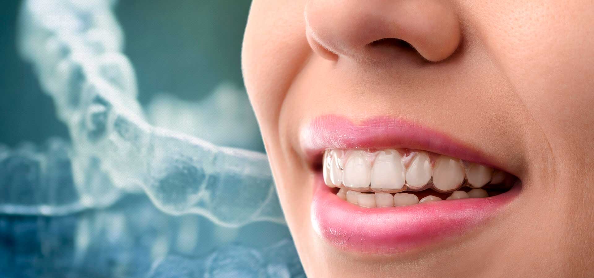 Выравнивание зубов элайнерами: инновационный подход к идеальной улыбке